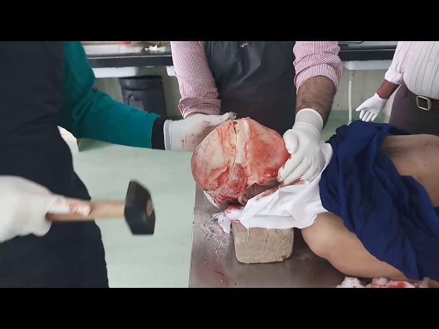 Steps of Autopsy Dissection | DocumentaryTube